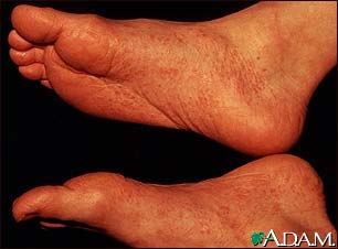 Reactive arthritis - view of the feet