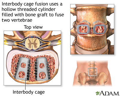Interbody cage fusion Interbody cage fusion
