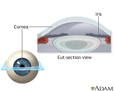 Lasik eye surgery - series - Normal anatomy Lasik eye surgery - series - Normal anatomy