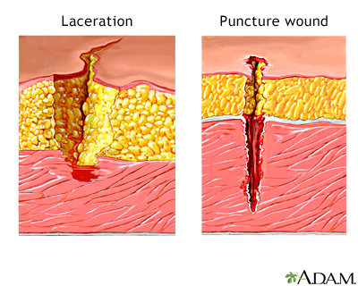 Laceration versus puncture wound Laceration versus puncture wound