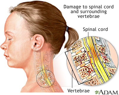 Spinal cord injury Spinal cord injury