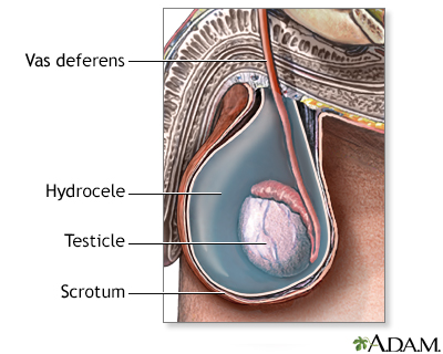 Hydrocele Hydrocele