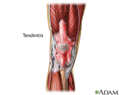 Tendinitis Tendinitis