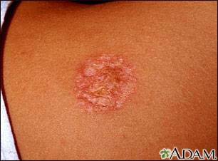 Necrobiosis lipoidica diabeticorum - abdomen Necrobiosis lipoidica diabeticorum - abdomen