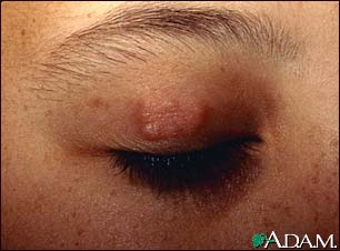 Granuloma annulare on the eyelid Granuloma annulare on the eyelid