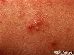 Acne - close-up of pustular lesions Acne - close-up of pustular lesions