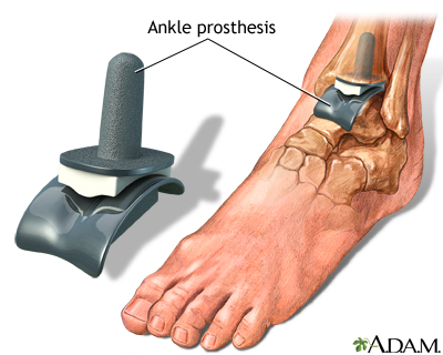 Ankle replacement Ankle replacement