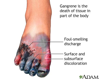 Gangrene Gangrene