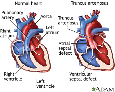 Truncus arteriosus Truncus arteriosus