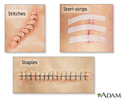 Incision closures Incision closures