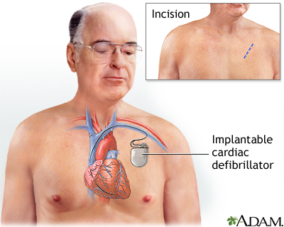 Implantable cardiac defibrillator Implantable cardiac defibrillator