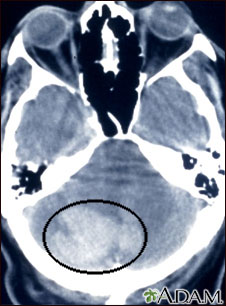 Intracerebellar hemorrhage - CT scan Intracerebellar hemorrhage - CT scan