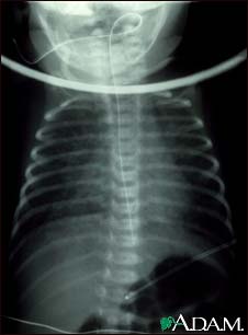 Totally anomalous pulmonary venous return - X-ray