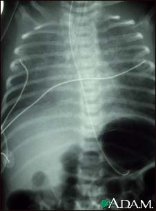 Totally anomalous pulmonary venous return - X-ray Totally anomalous pulmonary venous return - X-ray