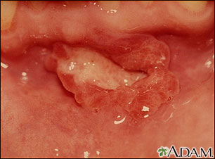 Canker sore (aphthous ulcer) Canker sore (aphthous ulcer)