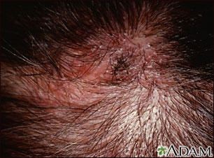 Ringworm, tinea capitis - close-up Ringworm, tinea capitis - close-up