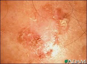 Actinic keratosis - close-up Actinic keratosis - close-up