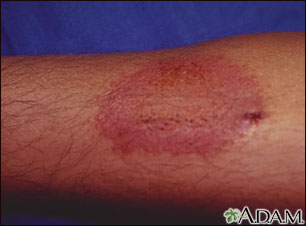 Dermatitis - contact