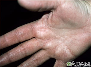Hyperlinearity in atopic dermatitis - on the palm Hyperlinearity in atopic dermatitis - on the palm