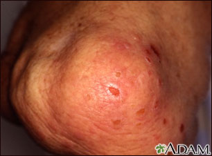 Dermatitis - herpetiformis on the knee Dermatitis - herpetiformis on the knee