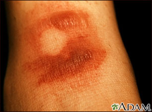 Fixed drug eruption - bullous Fixed drug eruption - bullous