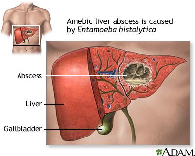 Amebic liver abscess