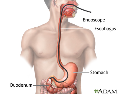 Esophagogastroduodenoscopy (EGD) Esophagogastroduodenoscopy (EGD)