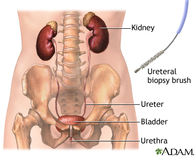 Ureteral biopsy