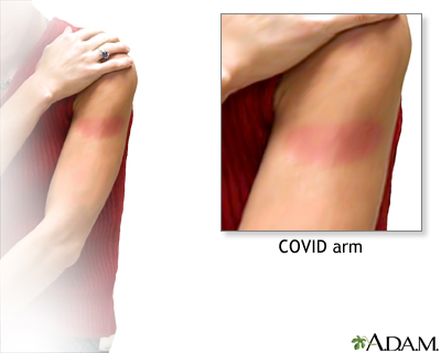 Arm Rash After COVID-19 Vaccination Arm Rash After COVID-19 Vaccination