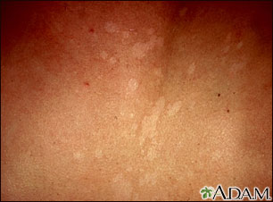 Tinea versicolor - close-up Tinea versicolor - close-up
