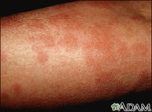 Hives (urticaria) on the arm Hives (urticaria) on the arm