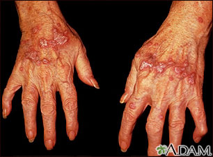 Lichen planus on the hands Lichen planus on the hands