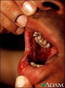 Pemphigus vulgaris - lesions in the mouth Pemphigus vulgaris - lesions in the mouth