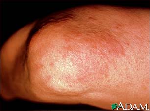 Granuloma annulare on the elbow