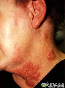 Herpes zoster (shingles) on the neck and cheek Herpes zoster (shingles) on the neck and cheek