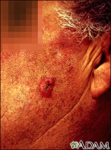 Squamous cell carcinoma - invasive Squamous cell carcinoma - invasive