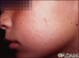 Keratosis pilaris on the cheek Keratosis pilaris on the cheek