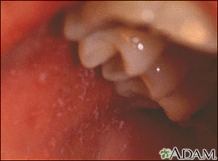 Measles, Koplik spots - close-up Measles, Koplik spots - close-up