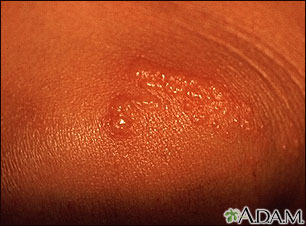 Poison ivy on the knee Poison ivy on the knee