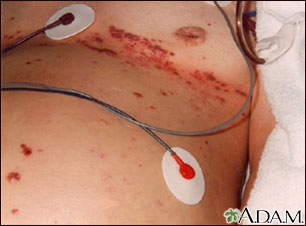 Herpes zoster (shingles) disseminated Herpes zoster (shingles) disseminated
