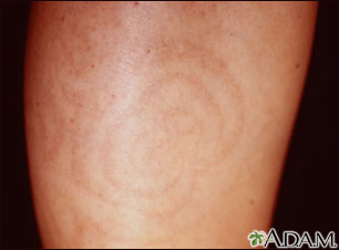 Post-inflammatory hyperpigmentation - calf Post-inflammatory hyperpigmentation - calf