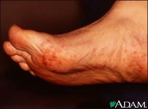 Cholesterol emboli Livedo Reticularis - feet Cholesterol emboli Livedo Reticularis - feet