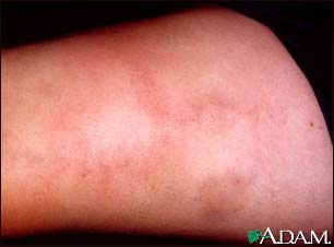 Superficial thrombophlebitis Superficial thrombophlebitis