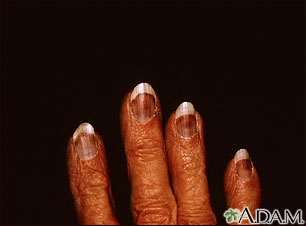 Cryoglobulinemia - fingers Cryoglobulinemia - fingers
