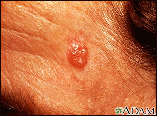 Basal Cell Carcinoma - face Basal Cell Carcinoma - face