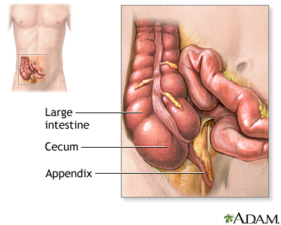 Appendectomy - series Appendectomy - series