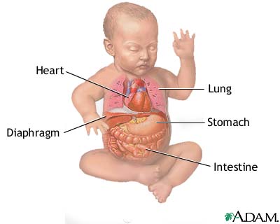 Diaphragmatic hernia repair - series Diaphragmatic hernia repair - series