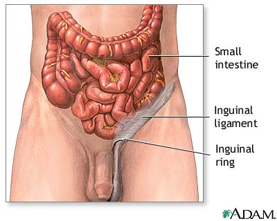 Inguinal hernia repair - series Inguinal hernia repair - series