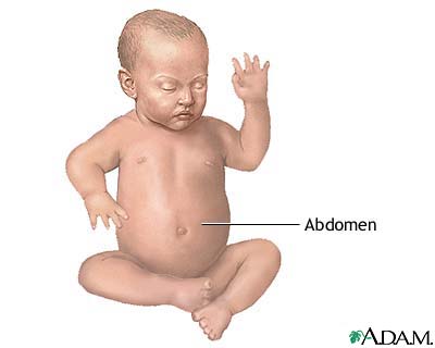 Omphalocele repair - series Omphalocele repair - series