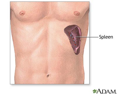 Spleen removal - series Spleen removal - series